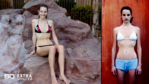 anorexica