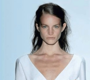 anorexica1