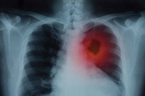 cancer pulmonar