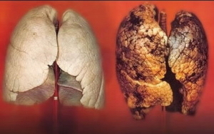 cancer de plamani