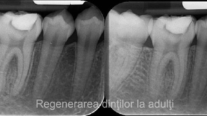 Regenerarea dintilor