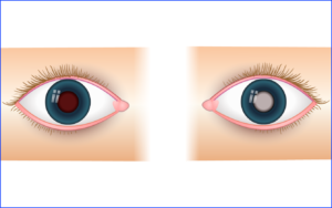 retinoblastom